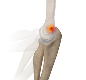 Posterior Impingement of the Elbow
