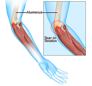 Tennis Elbow