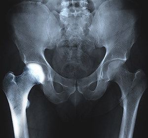 Transient-osteoporosis-of-the-hip