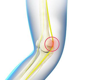ulnar-nerve-neuritis