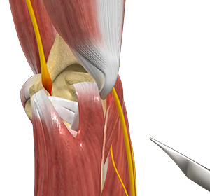 Ulnar Nerve Transposition