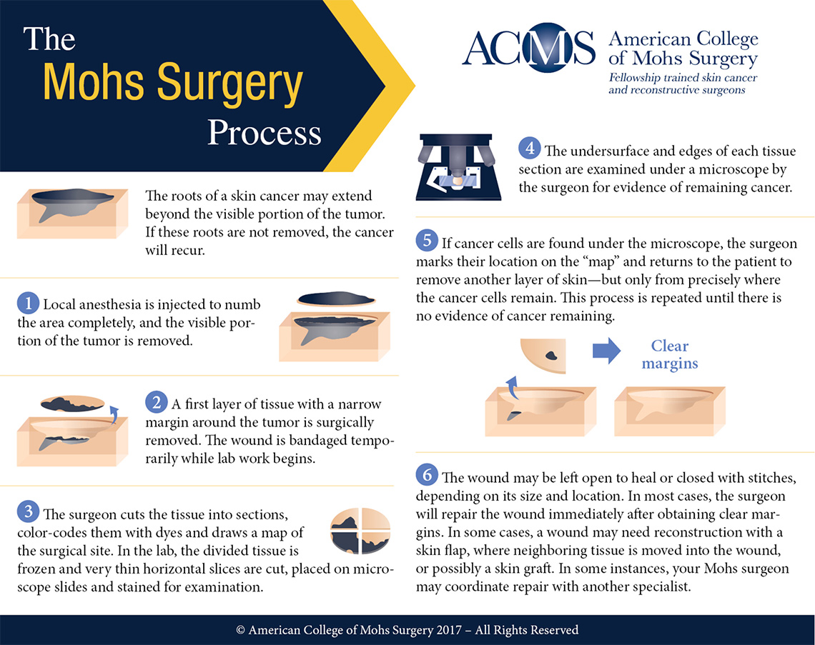 mohs-surgery-img
