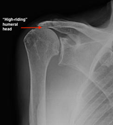 Shoulder with arthritis