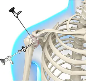 Arthroscopic Surgery