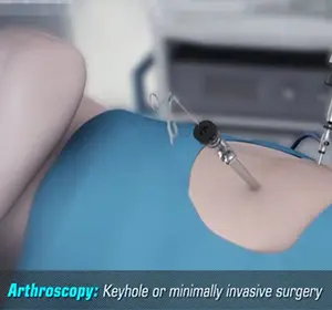Hip Arthroscopy