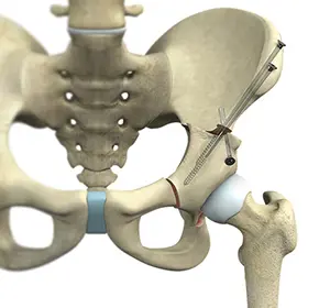 Hip Preservation Surgery