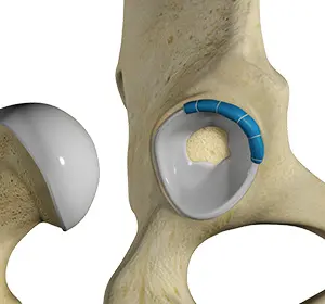 Hip Trauma Reconstruction