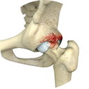 Femoroacetabular Impingement Services