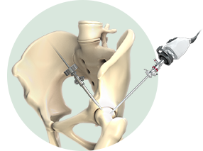 Hip Arthroscopy