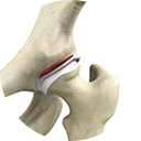 Hip Labral  Reconstruction Services