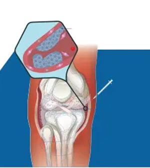 Arthrosamid® Injection