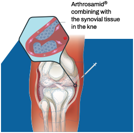 Arthrosamid® Work 