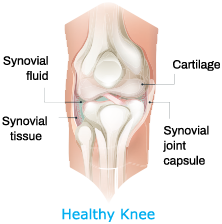 Arthrosamid® Injection 