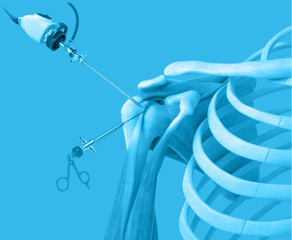 Minimally-Invasive Solutions Arthroscopic Keyhole Surgery