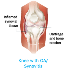 Arthrosamid® Injection 