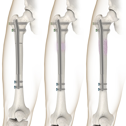 Minimally Invasive Limb Lengthening Frisco | Leg Lengthening