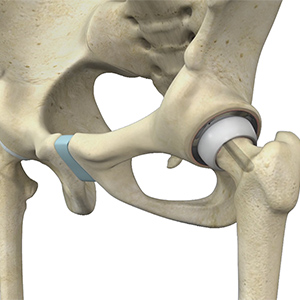 Hip Resurfacing