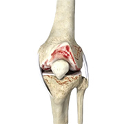 Inflammatory Arthritis of the Knee
