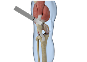 Subvastus Muscle-Sparing Total Knee Replacement