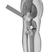 Subvastus Muscle Sparing Total Knee Replacement