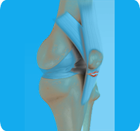 Patellar Tendon Rupture sp