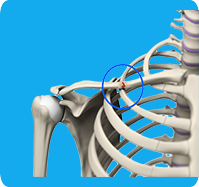 Clavicle Fracture sp