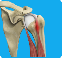 Proximal Biceps Tendinitis sp