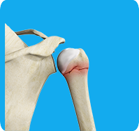 Proximal Humerus Fractures sp