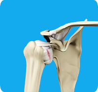 Shoulder Ligament Injuries sp