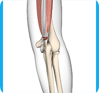 Triceps Tendon Rupture sp