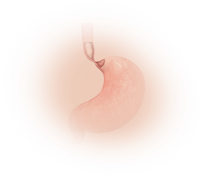 Achalasia