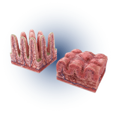 Celiac Disease