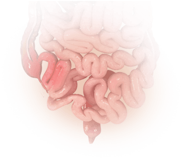 Crohn's Disease