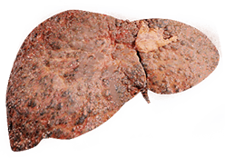Fatty Liver Disease