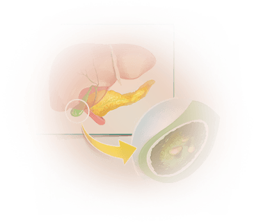 Gallbladder Disease
