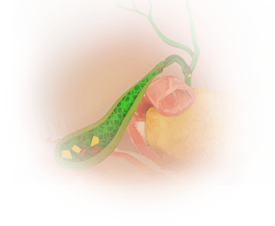 Gallstones