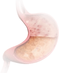 Gastritis