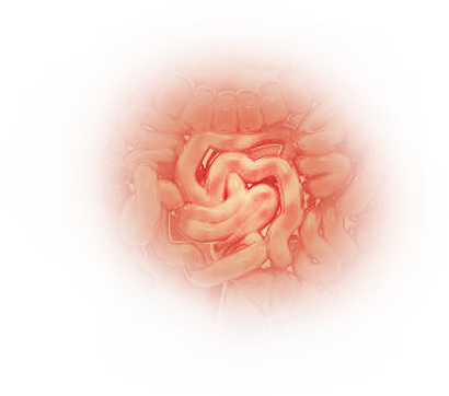 Irritable Bowel Syndrome