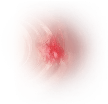 Lower Gastrointestinal Bleeding