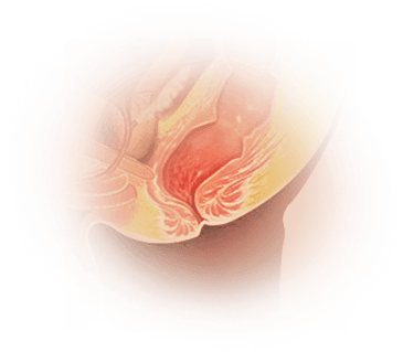 Rectal Bleeding