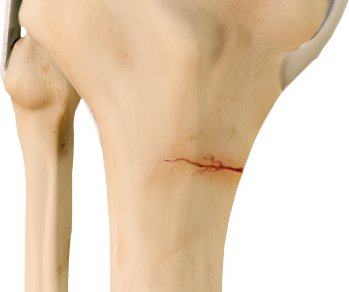 Picture of Knee Stress Fractures