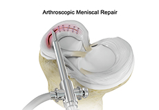 Meniscal Surgery logo