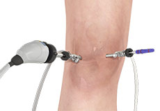 Knee arthroscopy img