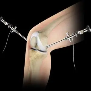 knee-arthroscopy1