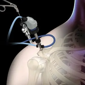 shoulder-arthroscopy2