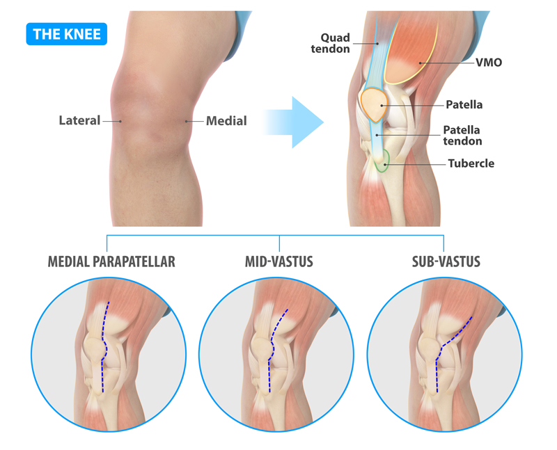 Subvastus Approach