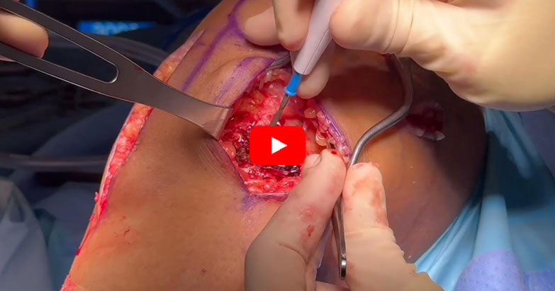 Anterior Tibial Slope Reducing Osteotomy for Revision ACL Reconstruction