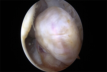 Cyclops lesion with knee in flexion