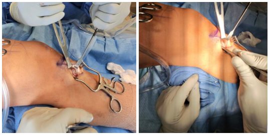 Patellar Tendinopathy