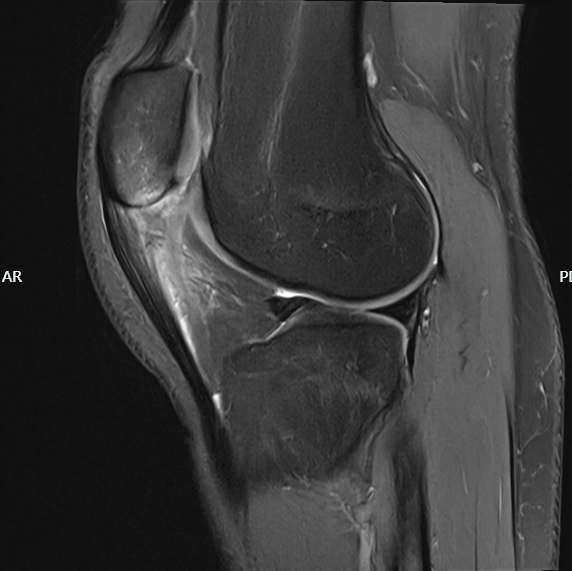 Patellar Tendinopathy